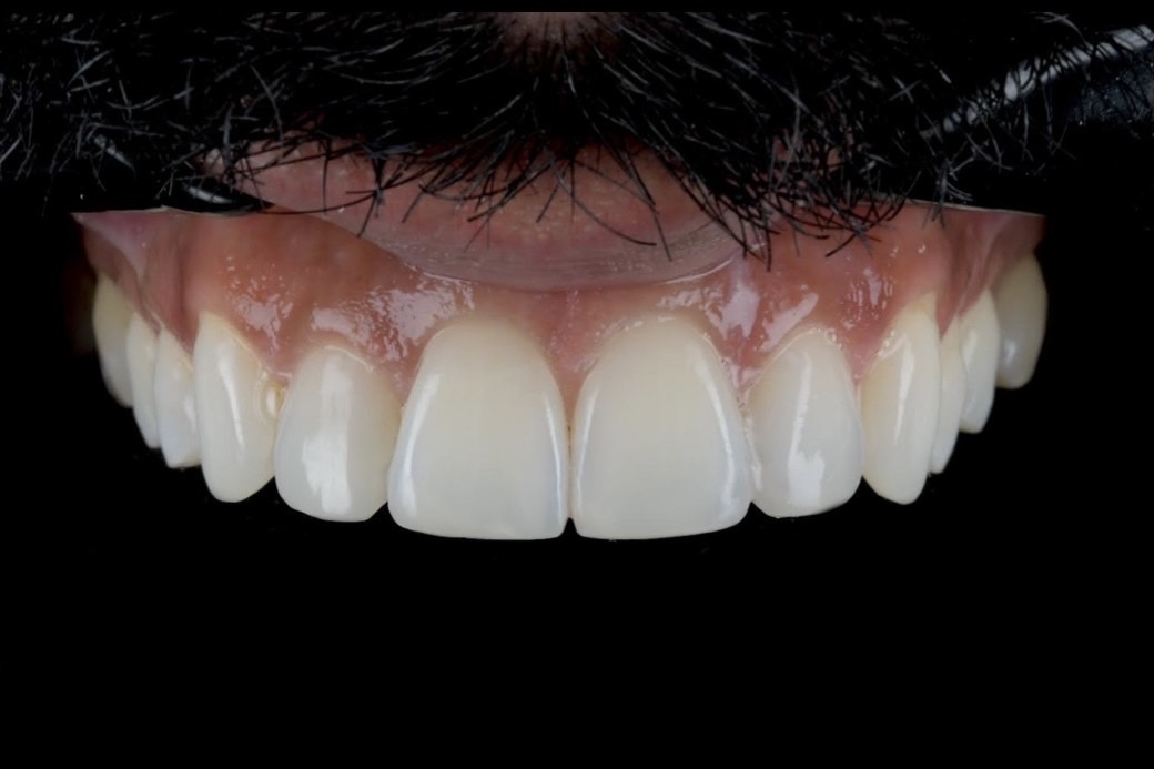 Composite Bonding 2 Post