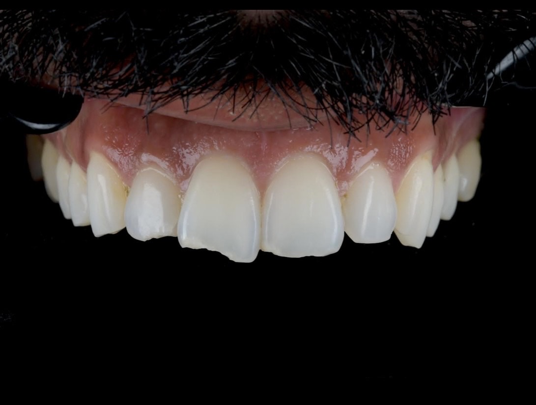 Composite Bonding 2 Pre