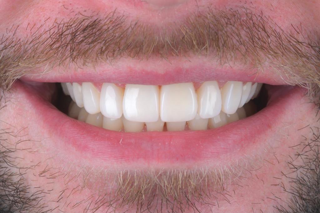 Composite Veneers 1 Post