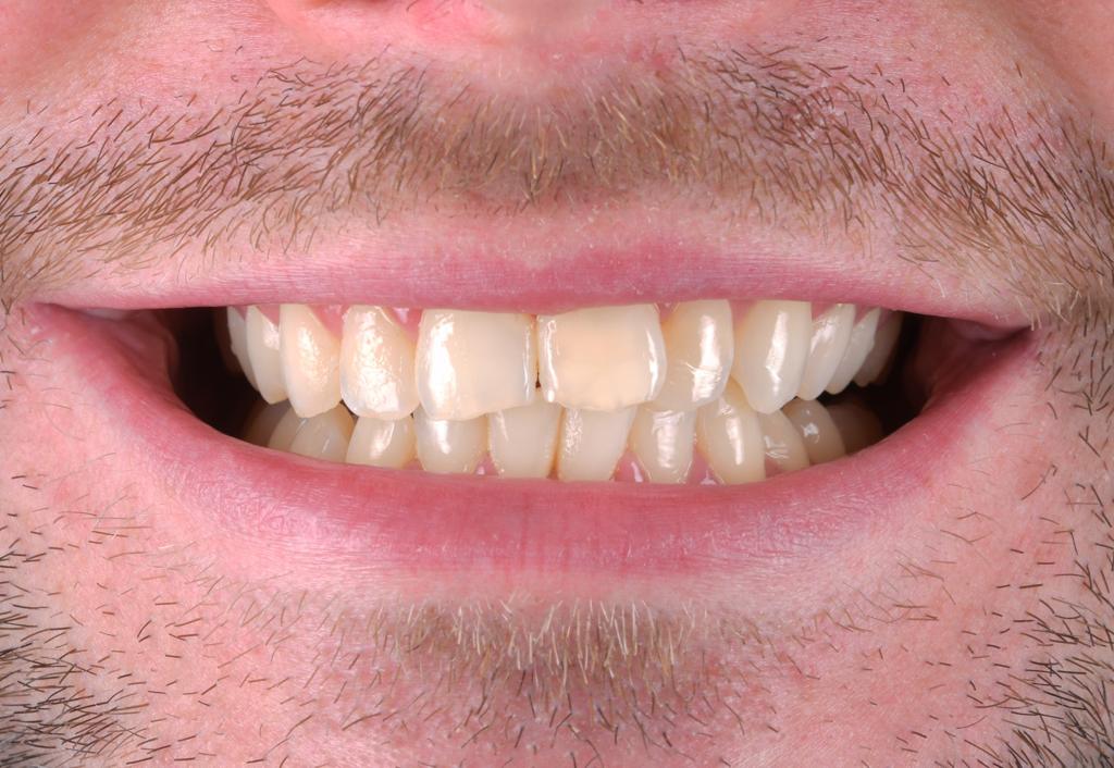 Composite Veneers 1 Pre