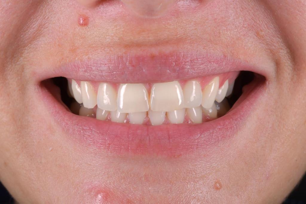 Composite Veneers 2 Pre