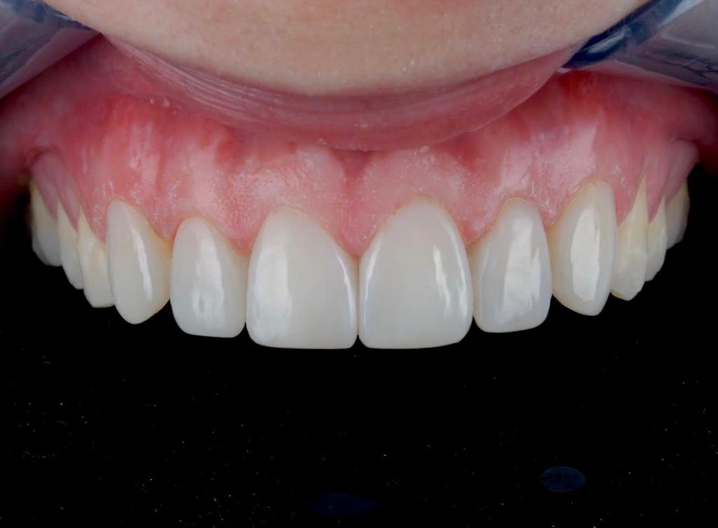Composite Veneers 3 Post
