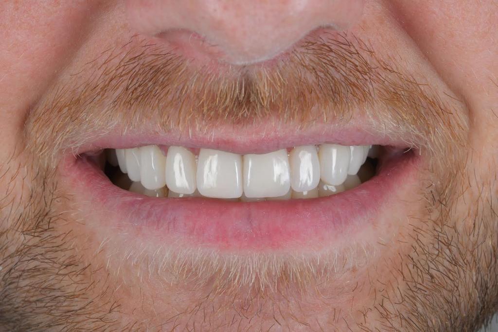 Composite Veneers 4 Post