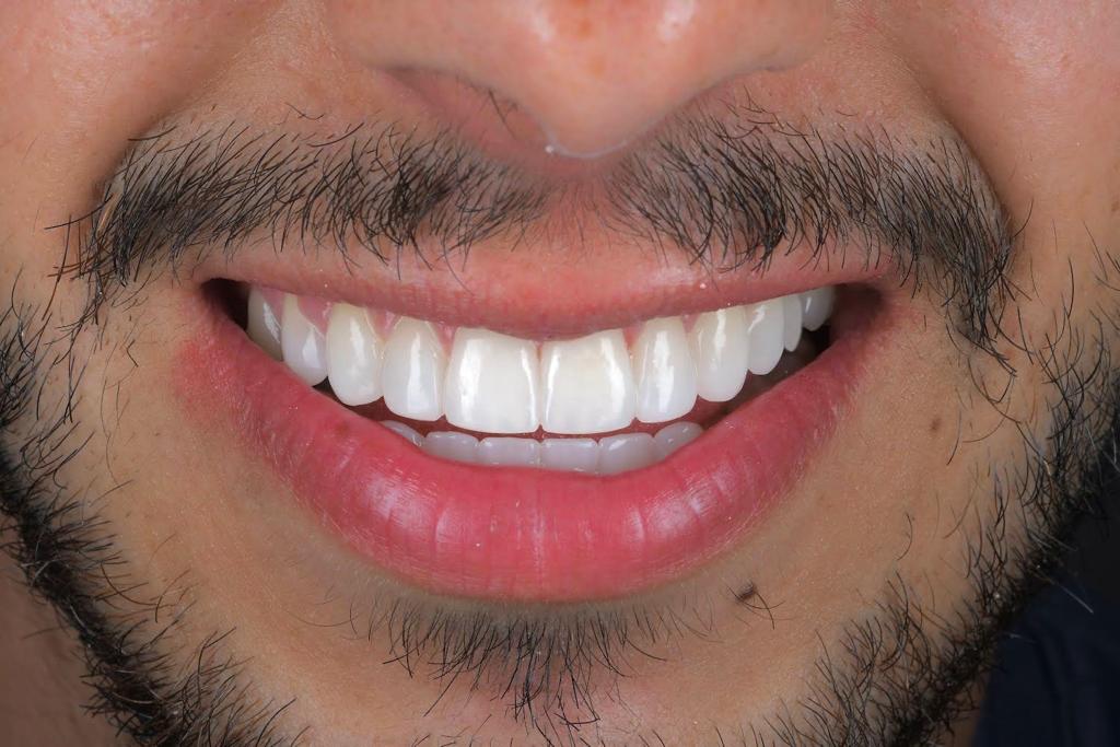 Composite Veneers 5 Post