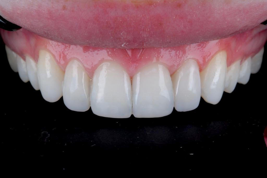 edgebonding